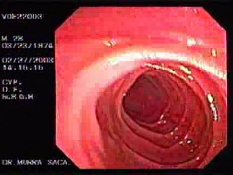 Familial Adenomatous Polyposis of the Colon (23 of 29)