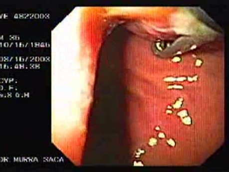 Flexible Endoscopic Suturing - Loosing the Tissues