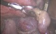 Broad Ligament Fibroid Rare Location. Laparoscopic Hysterectomy.