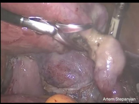 Broad Ligament Fibroid Rare Location. Laparoscopic Hysterectomy.