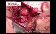 Organ Sparing Surgery for a Tumor of the Sole Kidney, Without a Clamp on the Renal Pedicle