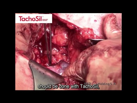 Organ Sparing Surgery for a Tumor of the Sole Kidney, Without a Clamp on the Renal Pedicle