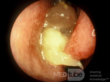 Nasal Polyps in the Patient with the ASA Triad