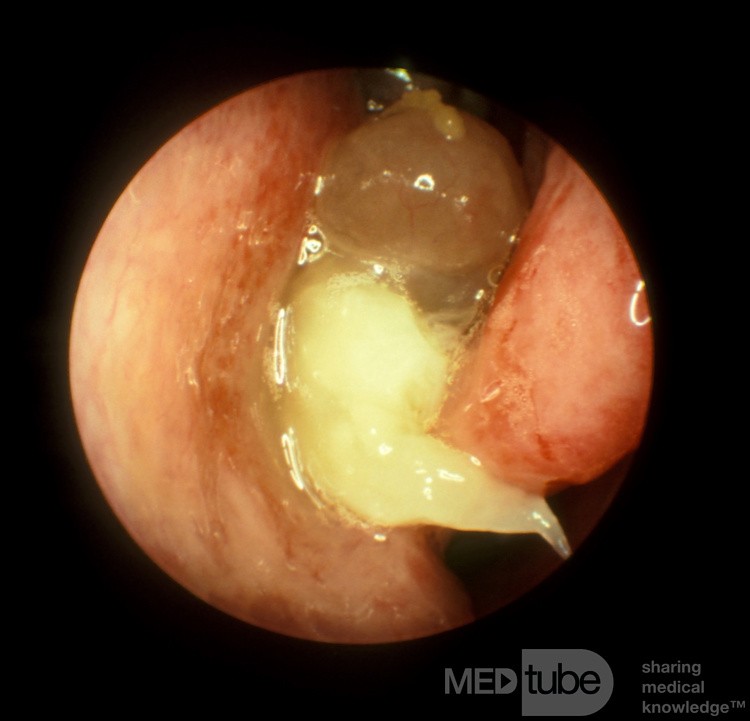 Nasal Polyps in the Patient with the ASA Triad