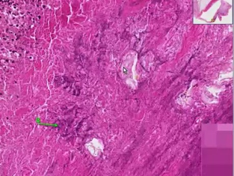 Bacterial endocarditis