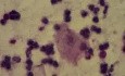 Man - Non-gonococcal urethritis (NGU) - Leukocytes