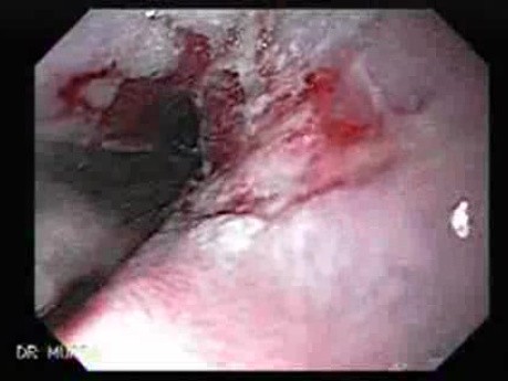Endoscopic Baloon Dilation Of The Esophageal Stricture - Inflating The Baloon