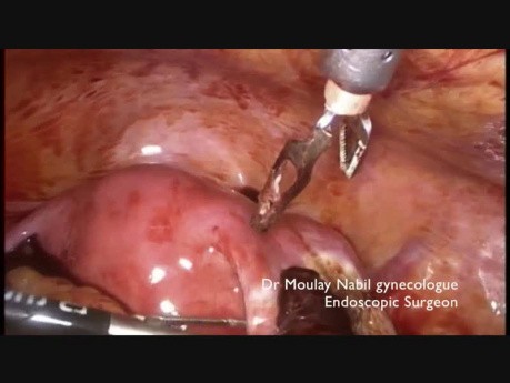 Emergency Laparoscopy for Ectopic Pregancy 