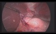 Organ-Preserving Surgery for Submucosal Tumor of Abdominal Esophagus