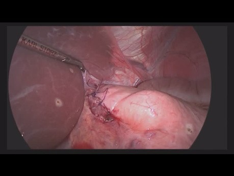 Organ-Preserving Surgery for Submucosal Tumor of Abdominal Esophagus