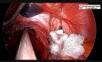 Laparoscopic Heller's Myomectomy with Appendectomy