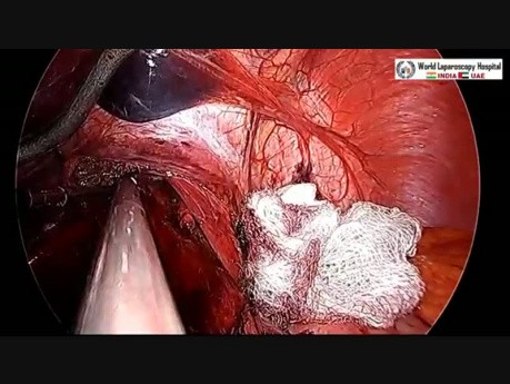 Laparoscopic Heller's Myomectomy with Appendectomy