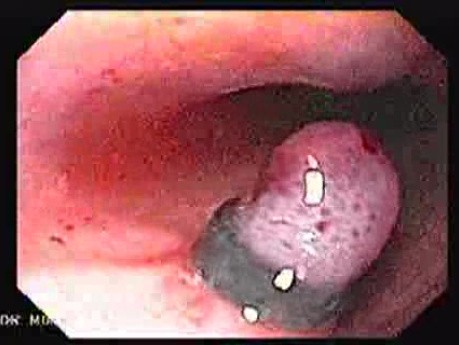 Endoscopic Variceal Ligation - Status Post Banding