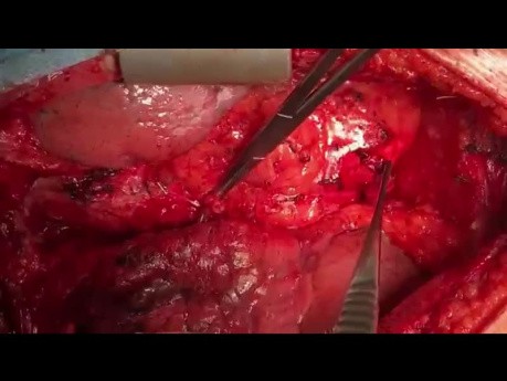 Redo CABG Off Pump