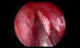 Endoscopic Septoplasty for Deviation of the Nasal Septum