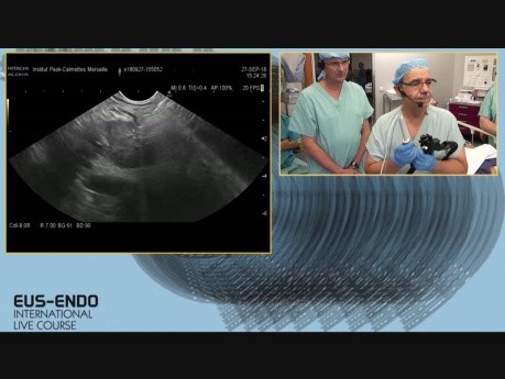 EUS Guided RFA of the Pancreatic Met