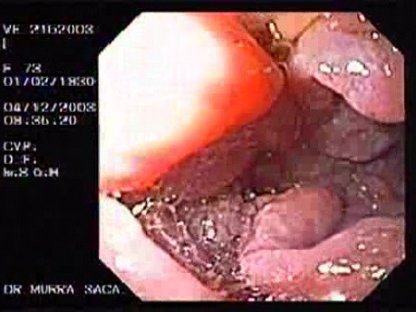 Duodenal B Cell Lymphoma (6 of 7)
