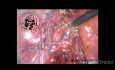 Laparoscopic Cholecystectomy and Common Bile Duct Exploration