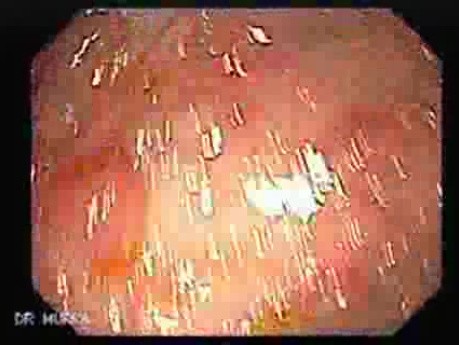 Familial Adenomatous Polyposis (9 of 36)