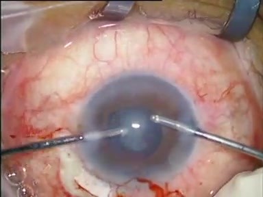 Combined Phaco Trab