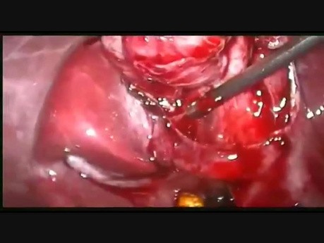 Necrotic Cystic Duc