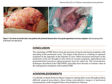Pseudomyxoma Peritonei - Publication About the Historical Concepts in this Disease WJGS