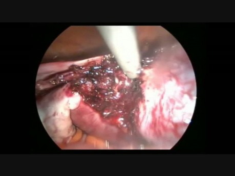 Lap Cronual Resection