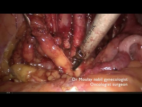 Didactic Procedure for Left Pelvic Lymphadenectomy