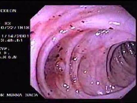 Diverticular Disease - Hemorrhage (11 of 15)