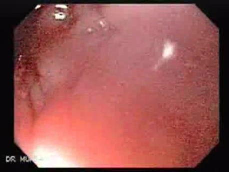Placement Of The Esophageal Stent - 2/12