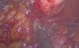 Diverticulitis Associated Colo-vesical fistula. Laparoscopic Treatment.