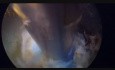 Left L4 PELAN Procedure, Endoscopic Spine Surgery