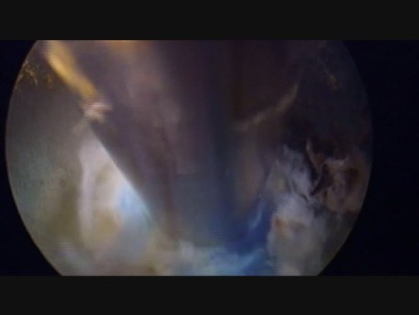 Left L4 PELAN Procedure, Endoscopic Spine Surgery
