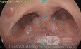 Lingual Tonsils