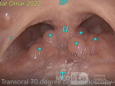 Lingual Tonsils