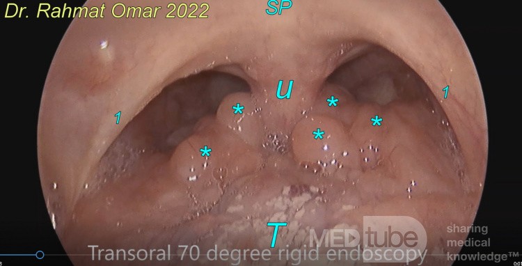 Lingual Tonsils