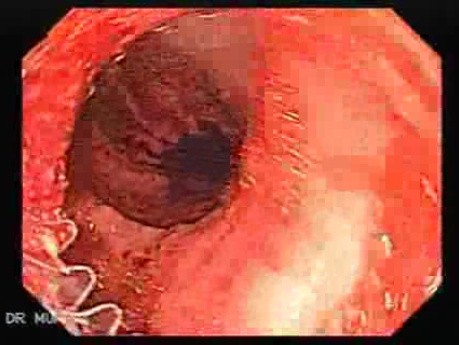 Placement Of The Esophageal Stent - 7/12