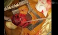 Minimally Invasive MV Replacement + TV Repair