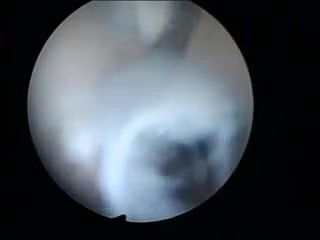 Sticking Walls of Endometrium as a Result of Intrauterine Trauma
