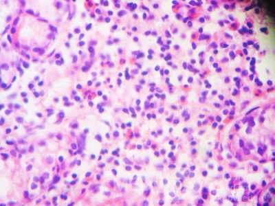 Eosinophilic Gastritis (5 of 7)