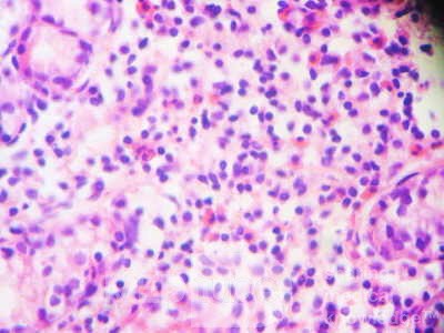 Eosinophilic Gastritis (5 of 7)
