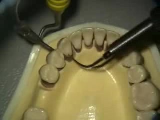 Ultrasonic Endoscopic  Debridement Simulation (LL, LA)