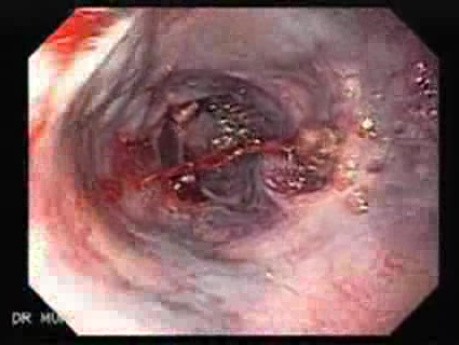 Severe Bleeding of the Upper Digestive System After Two Days of Band Ligation - Closer Look at the Varices