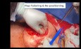 Reverse-Mirrored Grisotti Flap For Central Breast Cancer: El-Erian's Modification