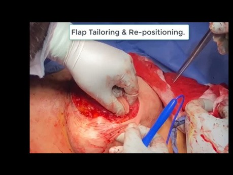 Reverse-Mirrored Grisotti Flap For Central Breast Cancer: El-Erian's Modification