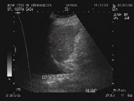 Ovarian Carcinoma with Gastric and Duodenal Metastases  - Left Pleural Effusion
