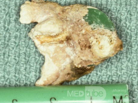 Rhinolith