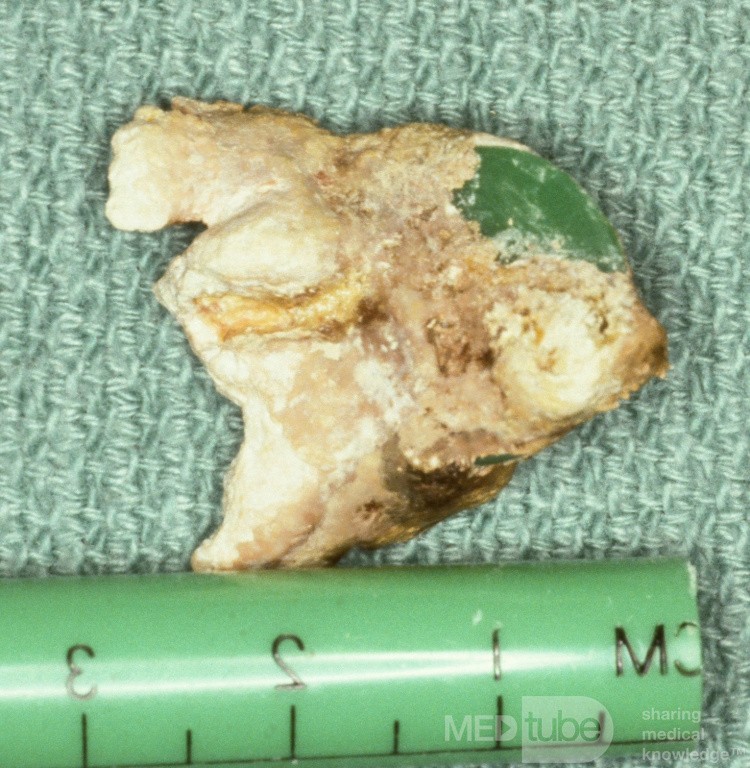 Rhinolith