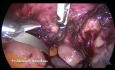 Total Laparoscopic Hysterectomy in case of adherent uterus to the anterior abdominal wall