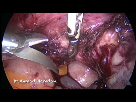 Total Laparoscopic Hysterectomy in case of adherent uterus to the anterior abdominal wall